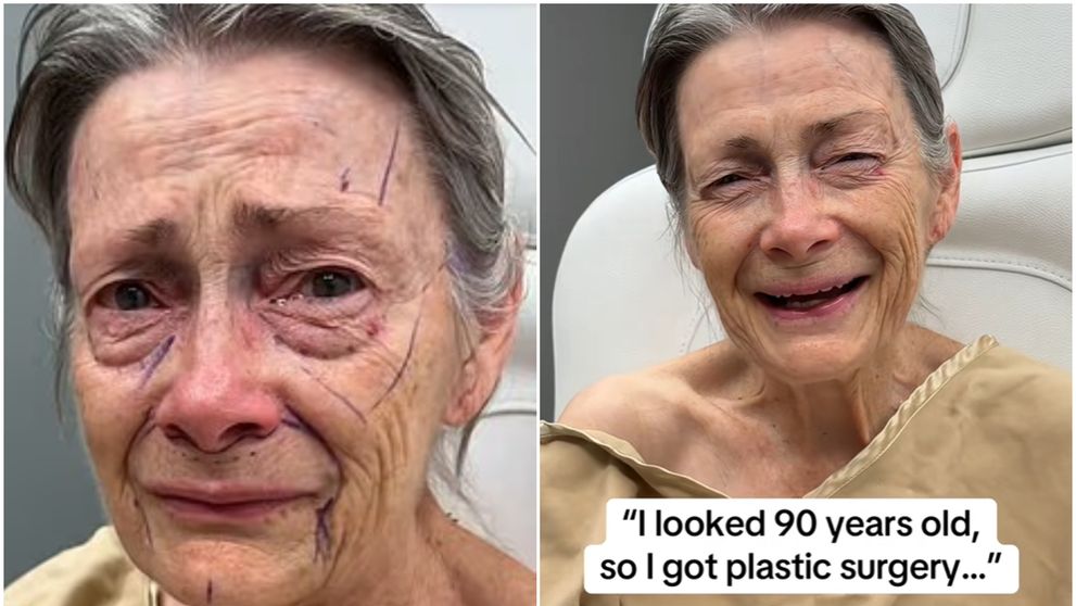 La 70 de ani și-a făcut un lifting facial, iar internauții au fost șocați de rezultat și l-au numit pe chirurgul plastician „omul-miracol”. Cum arată pensionara după procedura de întinerire