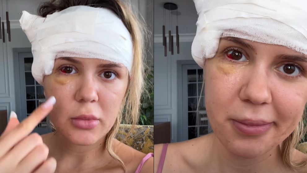 Emily Burghelea nu își poate reveni din șoc, după ce medicii au dat verdictul. Vedeta a primit un diagnostic ce a făcut-o să izbucnească în lacrimi: „Mi s-au mișcat oasele feței”