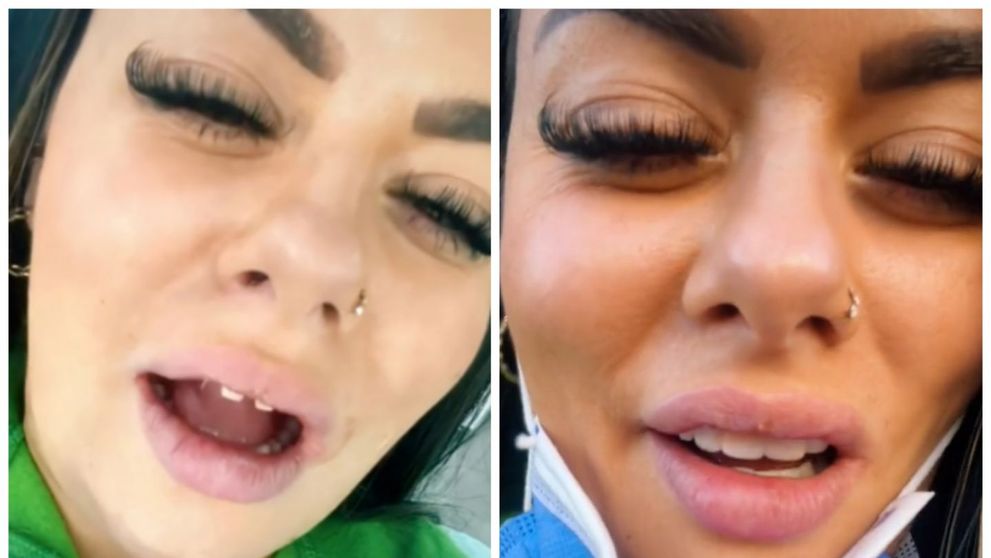 Prin ce chinuri a trecut o influenceriță de pe TikTok după ce și-a pus fațete dentare, de 42.000 de dolari