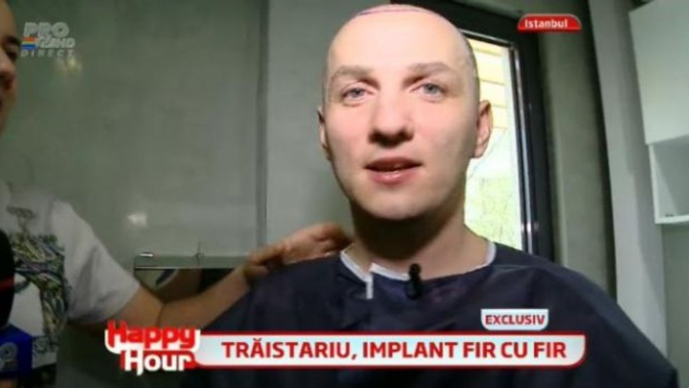 Transplantul de par a fost un succes. Lui Mihai Traistariu i-a crescut foarte mult parul si nu mai stie cum sa-l aranjeze: FOTO