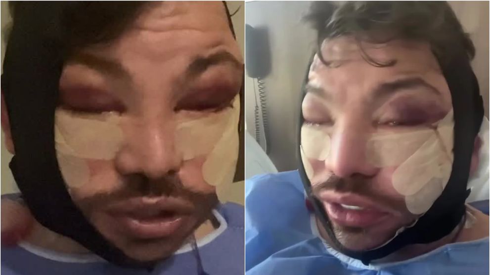 Operațiile estetice l-au distrus pur și simplu! S-a afișat cu fața tumefiată, nici nu mai poate vorbi, iar fanii sunt complet șocați: „Aștept procesul de vindecare”