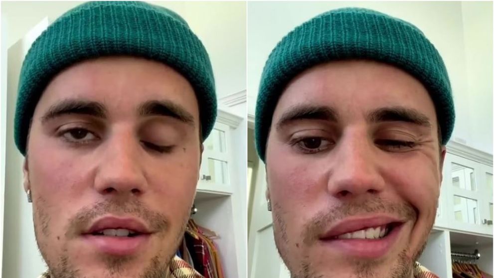 Justin Bieber, cu jumătate de față paralizată din cauza unei boli grave: “Vă rog, rugați-vă pentru mine”