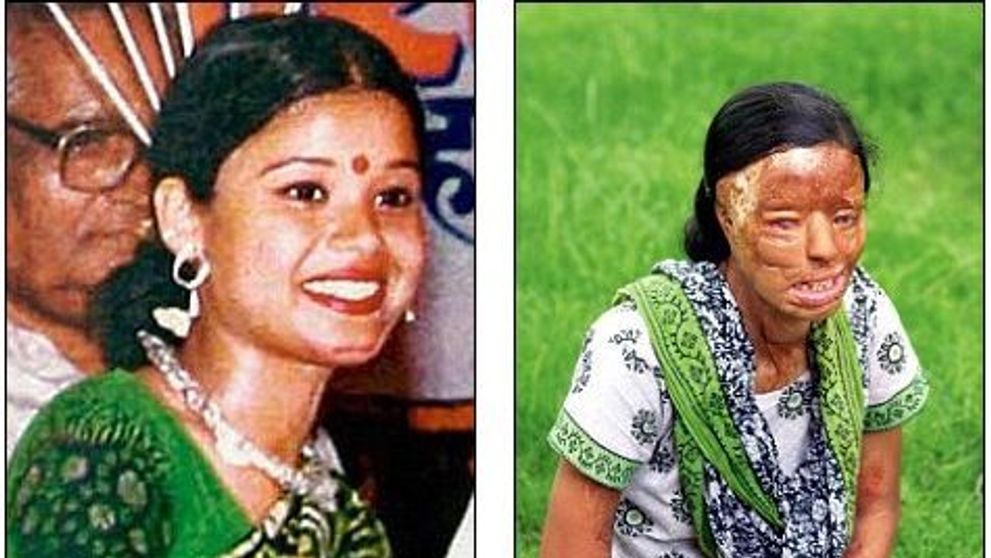 O tanara din India, a carei fata a fost distrusa intr-un atac cu acid, a castigat 
