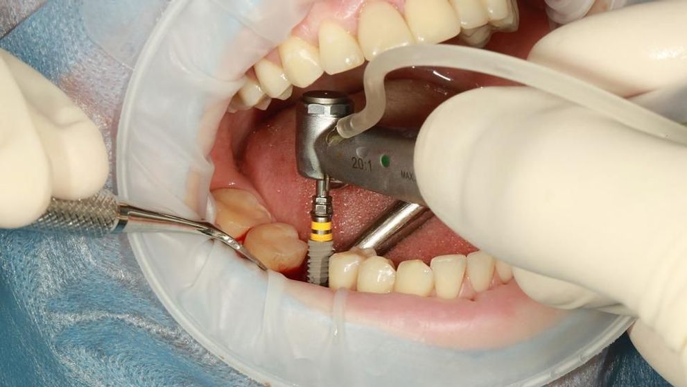 (P) Ai nevoie de un implant dentar? Iată ce trebuie să știi!