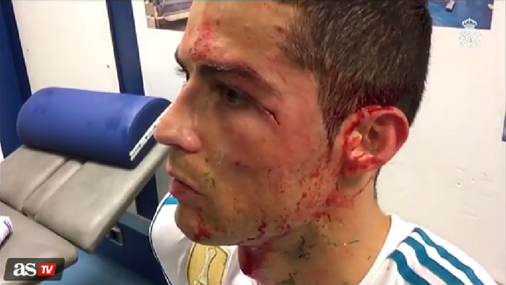 Cum arata fata lui Cristiano Ronaldo dupa ce i s-a cicatrizat taietura care l-a umplut de sange!