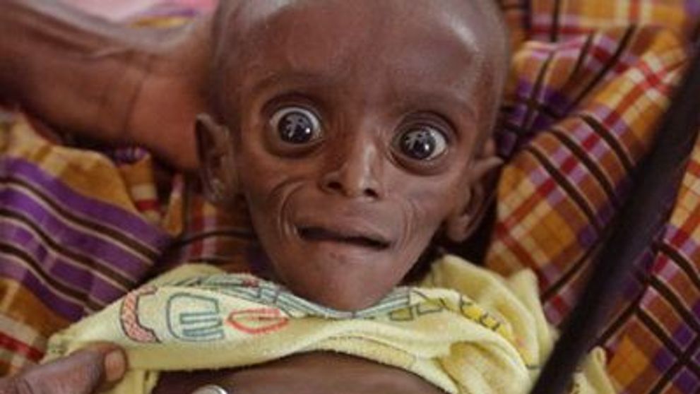 Imaginea zilei: Un bebelus subnutrit din Kenya  