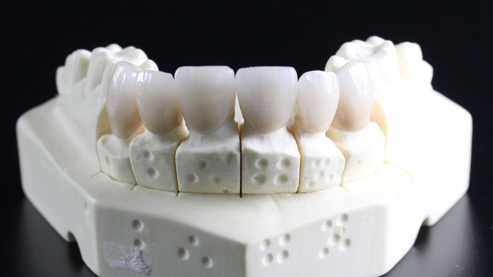 (P) Lucruri neadevărate spuse despre coroanele dentare