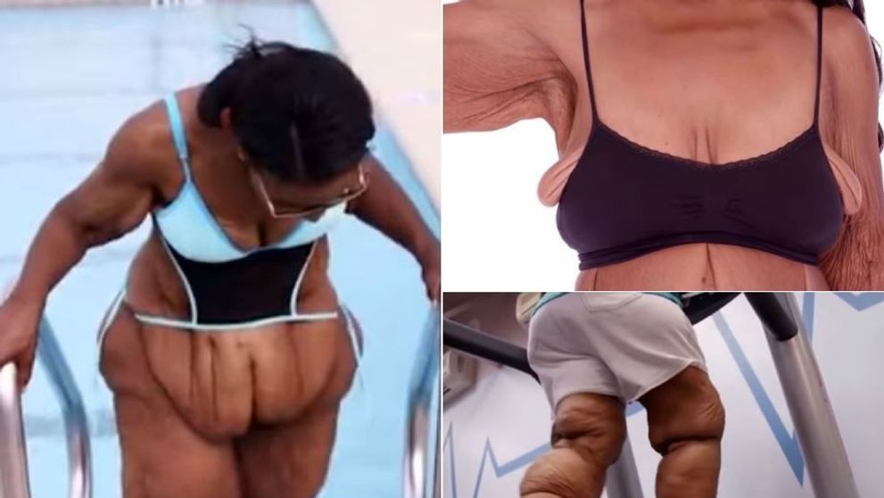 Surplusul de piele o facea sa regrete ca a slabit peste 90 de kilograme. Operatia care a urmat i-a schimbat viata