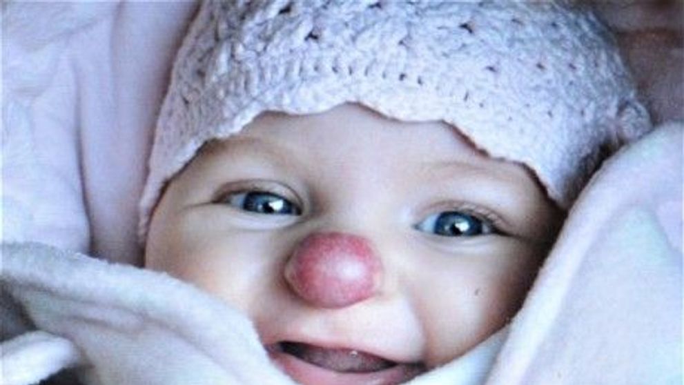 O fetita s-a nascut cu nas de clovn. Afla-i povestea bizara, care a inceput cu un punctulet rosu pe nas