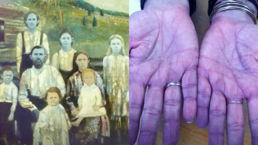 Membrii unei familii s-au înrudit atât de mult, încât pielea lor a devenit albastră. Mărturiile unuia dintre descendenți