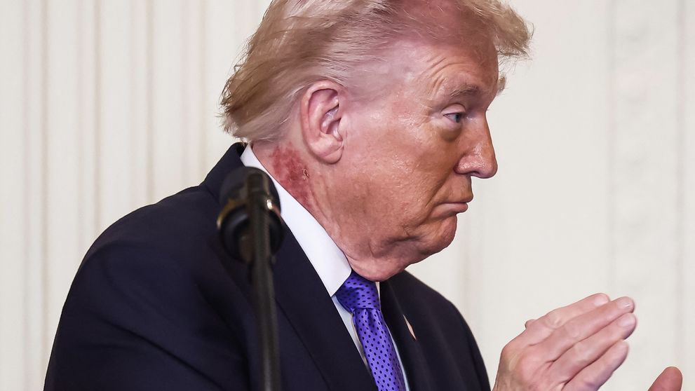 Imaginile care au stârnit îngrijorare! Ce este pata roșie apărută pe gâtul lui Donald Trump
