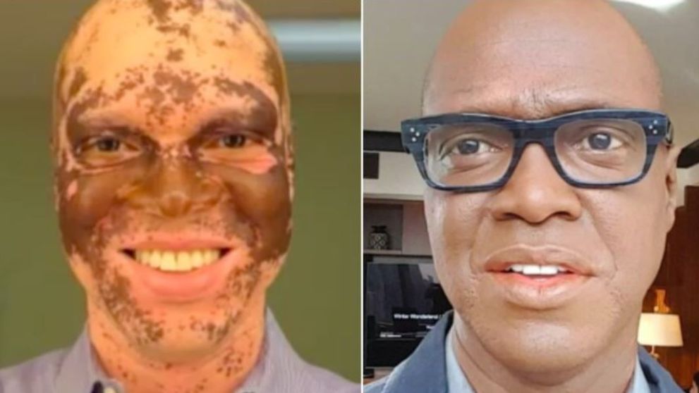 Sufera de vitiligo si este nevoit sa se machieze in fiecare zi pentru a nu-si pierde slujba