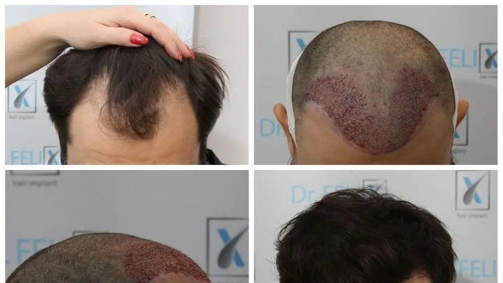 (P) Detalii despre implant de păr pe drfelixhairimplant.ro și în acest articol