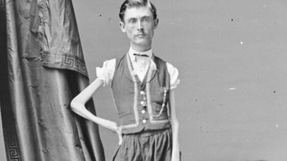 Povestea cutremurătoare a lui Isaac Sprague, poreclit „Scheletul Viu”. Bărbatul cântărea, la maturitate, doar 19 kilograme